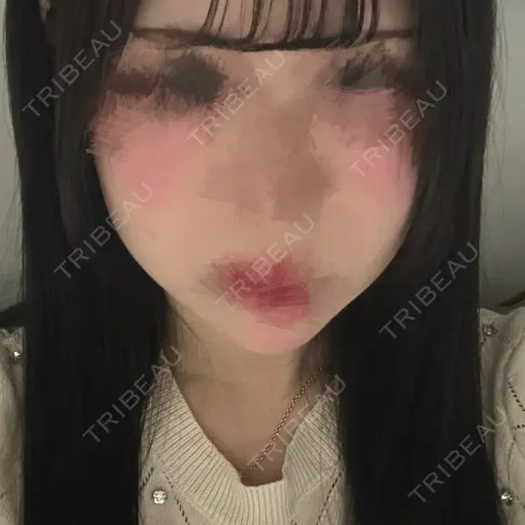 ボトックス（あご） / ヒアルロン酸注入（あご） / ボトックス（エラ・小顔） SUNMELIA SKIN CLINIC AFTER メイン用