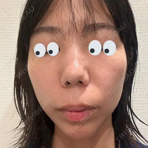 水光注射（ハリ・美肌） / マイクロボトックス DAILY SKIN CLINIC 心斎橋院 AFTER メイン用