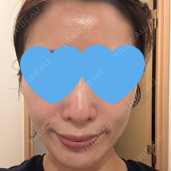 光治療（フォトフェイシャルなど） RainBoW Clinic TOKYO DAY 0 メイン用