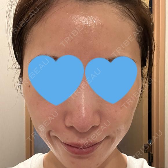 光治療（フォトフェイシャルなど） RainBoW Clinic TOKYO DAY 1 メイン用