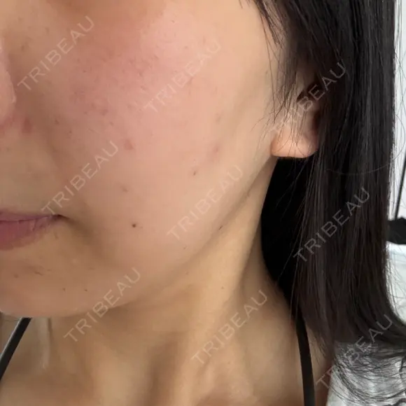 ほくろ・いぼ切除（肌） KARIS beauty clinic AFTER メイン用