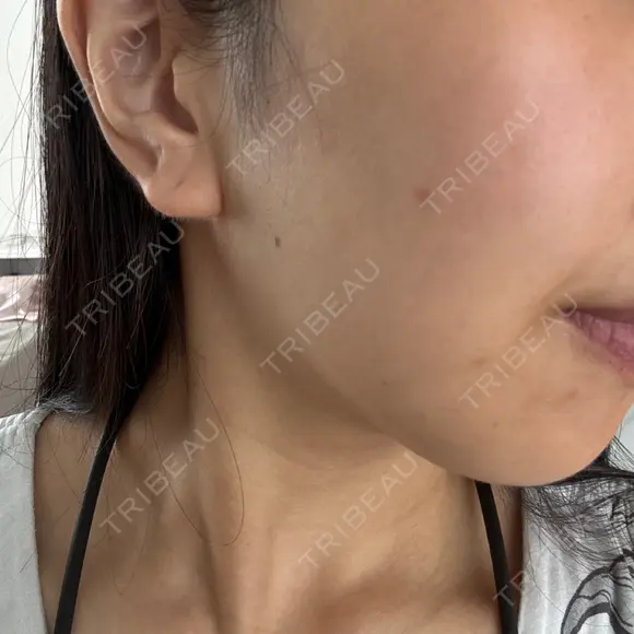 ほくろ・いぼ切除（肌） KARIS beauty clinic DAY 220 メイン用