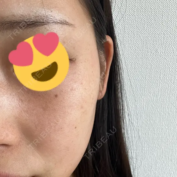 ピーリング（ハリ・ツヤ） / ルメッカ PureMe Skin Clinic（ピュアミースキンクリニック麻布） DAY 2 メイン用