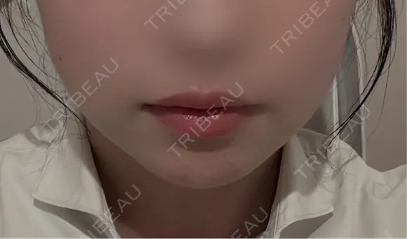 脂肪吸引（顔） ネビュラクリニック 京都院 AFTER メイン用