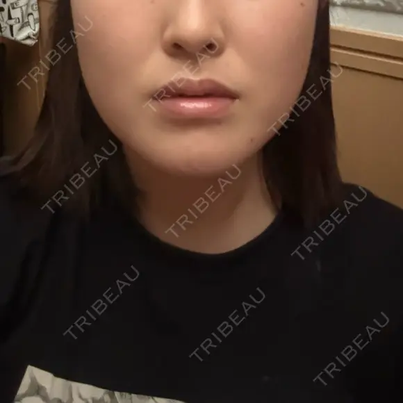 ハイフ（顔） AZ BEAUTY CLINIC AFTER メイン用