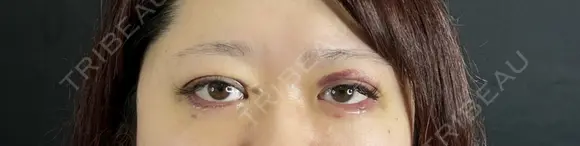 二重埋没 / 眼瞼下垂（切開） / 上まぶたの脂肪取り 藤・ナチュレ美容クリニック 銀座院 DAY 7 メイン用