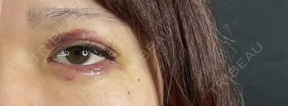 二重埋没 / 眼瞼下垂（切開） / 上まぶたの脂肪取り 藤・ナチュレ美容クリニック 銀座院 DAY 7 メイン用