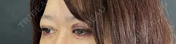 二重埋没 / 眼瞼下垂（切開） / 上まぶたの脂肪取り 藤・ナチュレ美容クリニック 銀座院 DAY 7 メイン用