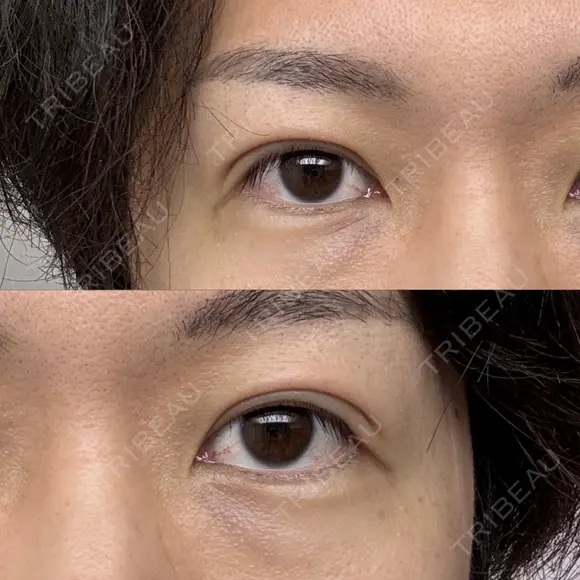 二重埋没 けやき美容クリニック 沼津院 DAY 14 メイン用