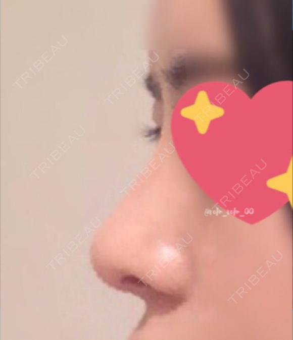 鼻尖形成（切開） / 鼻中隔延長（切開） / 軟骨移植 / 眉間プロテーゼ / 鼻修正 ミナ美容外科 DAY 91 メイン用