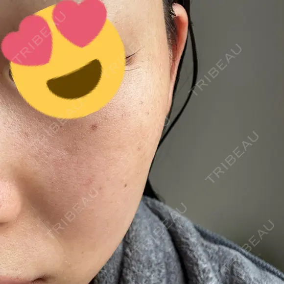 ピーリング（ハリ・ツヤ） / ルメッカ PureMe Skin Clinic（ピュアミースキンクリニック麻布） DAY 3 メイン用