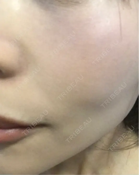 毛穴洗浄（ハイドラフェイシャルなど） / ルメッカ ON-CLINIC Beauty DAY 1 メイン用