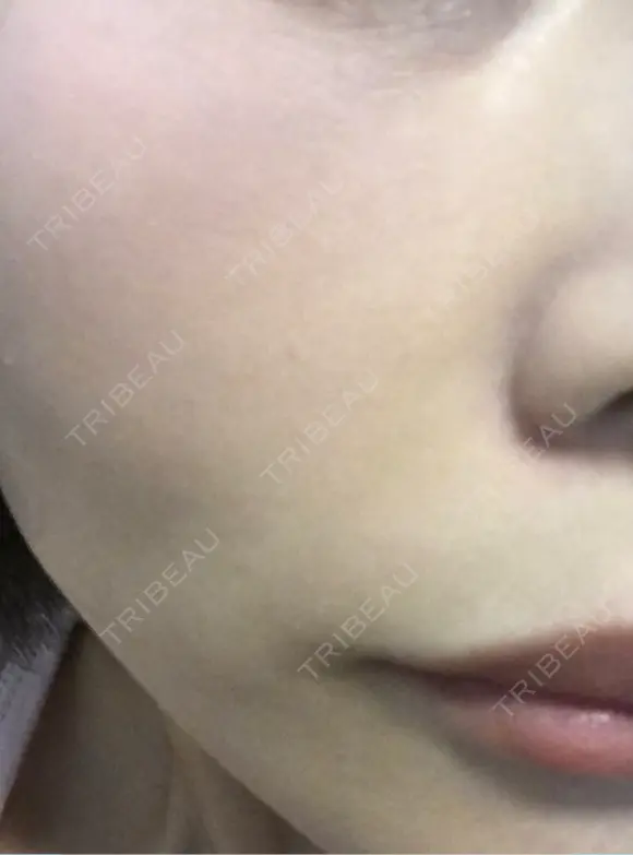 毛穴洗浄（ハイドラフェイシャルなど） / ルメッカ ON-CLINIC Beauty DAY 1 メイン用