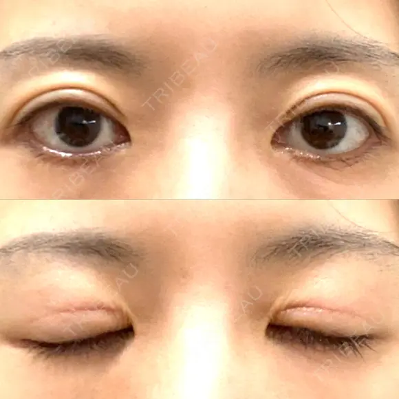 眼瞼下垂（切開） WOM CLINIC GINZA （ワム クリニック ギンザ） AFTER メイン用