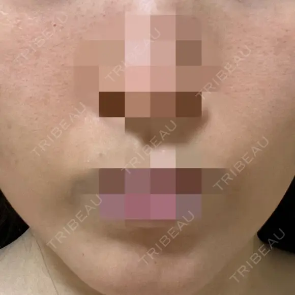 ニードルRF（ポテンツァなど） ながしま形成外科クリニック DAY 1 メイン用