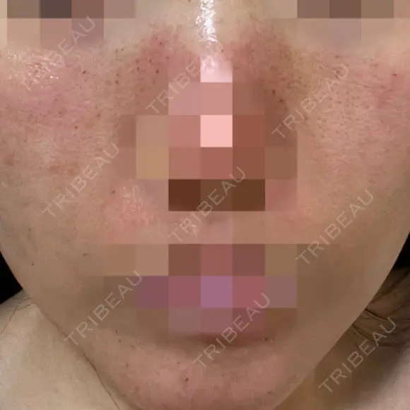 ニードルRF（ポテンツァなど） ながしま形成外科クリニック DAY 0 メイン用