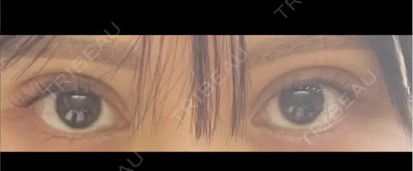 二重埋没 Stand by Beauty Clinic DAY 2 メイン用