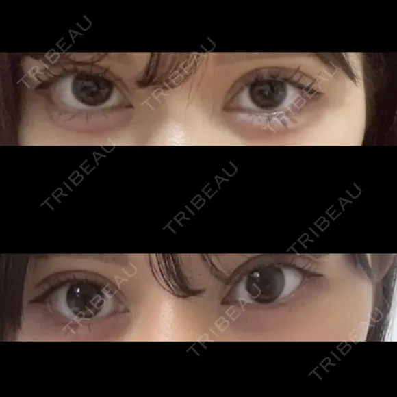 二重埋没 Stand by Beauty Clinic DAY 15 メイン用