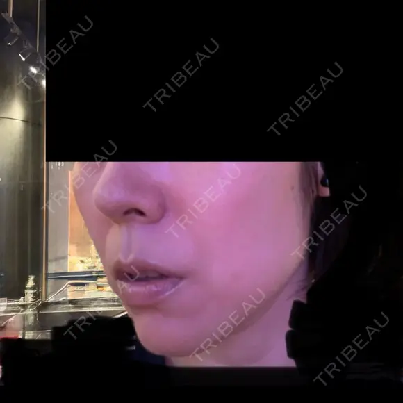 ハイフ（顔） / 毛穴洗浄（ハイドラフェイシャルなど） S-Laboクリニック 渋谷院 DAY 0 メイン用