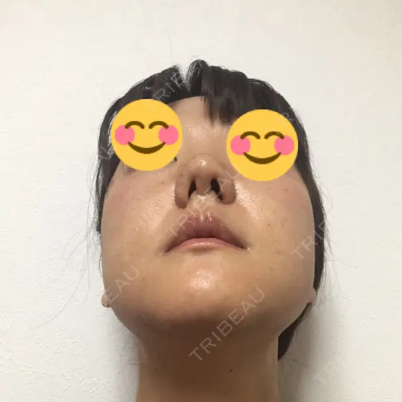 鼻尖形成（切開） / 小鼻縮小（切開） / 鼻尖縮小 湘南美容クリニック 神戸院 DAY 23 メイン用