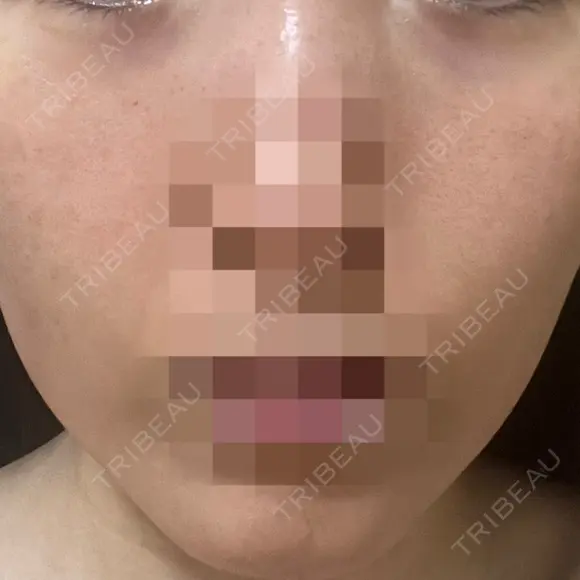 ニードルRF（ポテンツァなど） ながしま形成外科クリニック DAY 2 メイン用