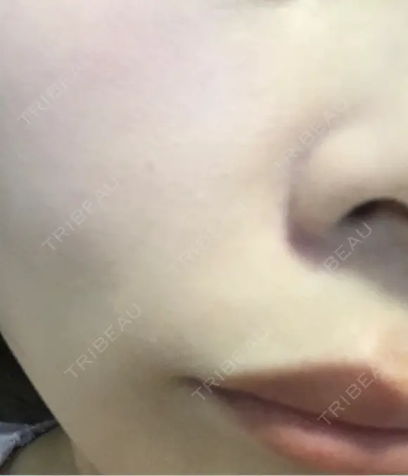 毛穴洗浄（ハイドラフェイシャルなど） / ルメッカ ON-CLINIC Beauty DAY 2 メイン用