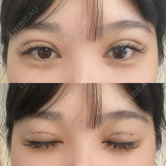 二重埋没 / RF（高周波）たるみ治療 Wing clinic 豊中駅前院 DAY 0 メイン用