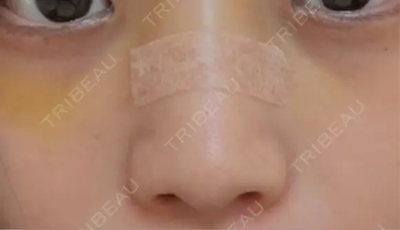 鼻尖形成（切開） / ワシ鼻修正・ハンプ切除 / 眉間プロテーゼ / 鼻柱下降・鼻唇角形成（猫手術） / ヒアルロン酸注入（額） グローバルビューティークリニック 大阪院 DAY 9 メイン用