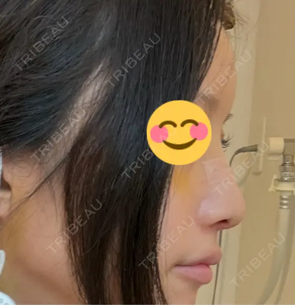鼻尖形成（切開） / ワシ鼻修正・ハンプ切除 / 眉間プロテーゼ / 鼻柱下降・鼻唇角形成（猫手術） / ヒアルロン酸注入（額） グローバルビューティークリニック 大阪院 DAY 9 メイン用