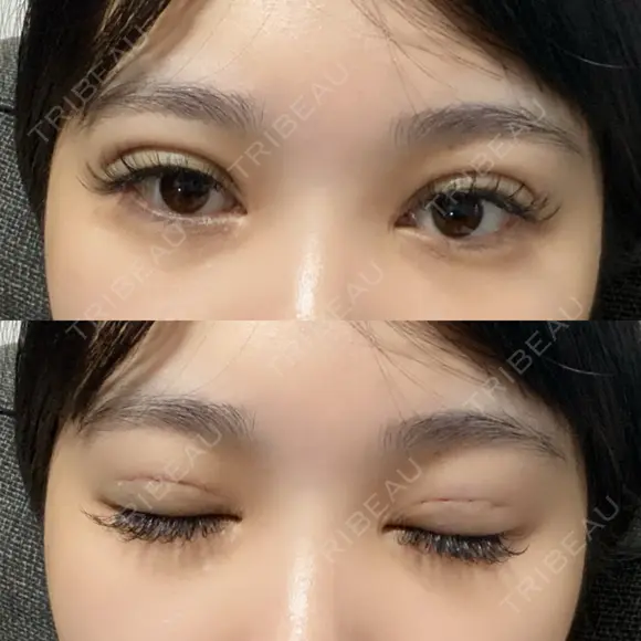 二重埋没 / RF（高周波）たるみ治療 Wing clinic 豊中駅前院 DAY 1 メイン用