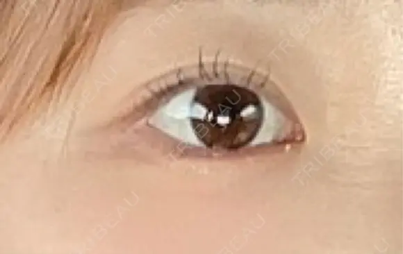 二重切開 Olino美容外科・美容皮膚科 AFTER メイン用