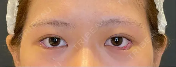 目尻切開 / タレ目形成・グラマラスライン（埋没） LOUIS CLINIC 二子玉川院【ルイクリニック】 DAY 0 メイン用