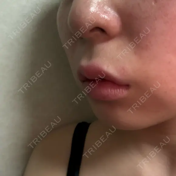 ヒアルロン酸注入（唇） / ボトックス（口角） / RF（高周波）たるみ治療 ルラ美容クリニック 京都院 DAY 5 メイン用