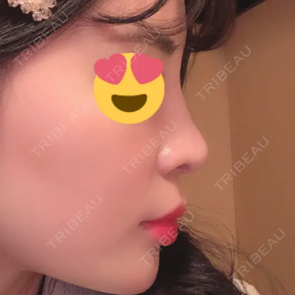 隆鼻術 / 鼻尖形成（切開） / 鼻中隔延長（切開） / 軟骨移植 / 骨切幅寄せ / 斜鼻修正 / 鼻修正 / 鼻尖縮小 GNG美容外科 DAY 84 メイン用