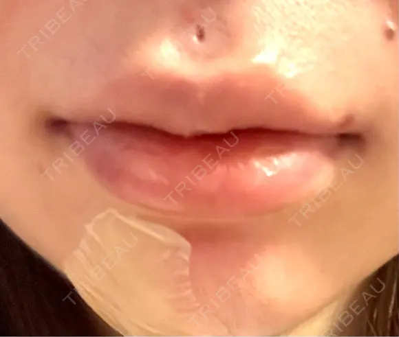 ヒアルロン酸注入（唇） / ボトックス（口角） BITO BEAUTY CLINIC AFTER メイン用