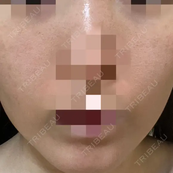 ニードルRF（ポテンツァなど） ながしま形成外科クリニック DAY 3 メイン用