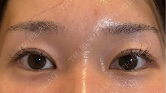 二重切開 / 目元修正 こまちクリニック AFTER メイン用