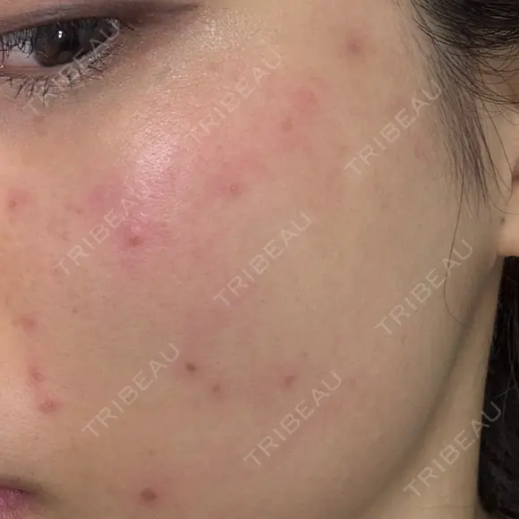 ピコスポット ビューティー和心クリニック 浅草院 DAY 0 メイン用