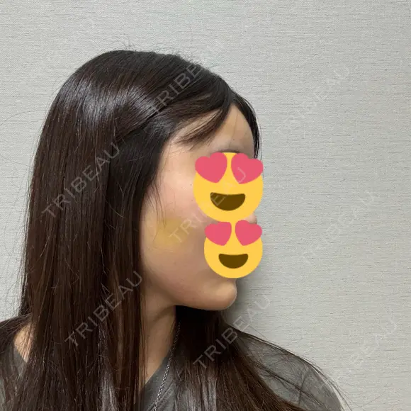 脂肪吸引（顔） / 脂肪吸引（脚） / 脂肪注入（肌） / 脂肪注入（額） / 脂肪注入（目の下） / 脂肪注入（輪郭） ヴェルトラクリニック 新宿院 DAY 6 メイン用