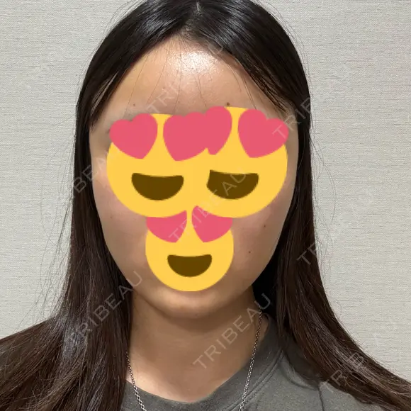 脂肪吸引（顔） / 脂肪吸引（脚） / 脂肪注入（肌） / 脂肪注入（額） / 脂肪注入（目の下） / 脂肪注入（輪郭） ヴェルトラクリニック 新宿院 DAY 6 メイン用