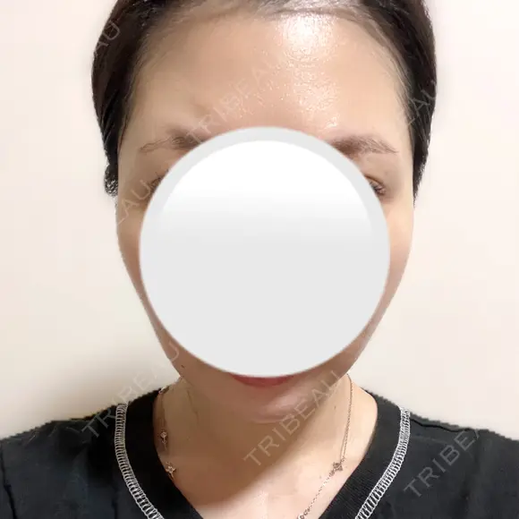 糸リフト / バッカルファット除去 / 脂肪吸引（顔） / ジョールファット除去 / ボトックス（あご） / ボトックス（エラ・小顔） アリエル美容クリニック 大宮院 DAY 52 メイン用