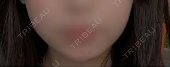 ボトックス（あご） / ヒアルロン酸注入（あご） / ボトックス（エラ・小顔） TCB東京中央美容外科 京都駅前院 DAY 185 メイン用