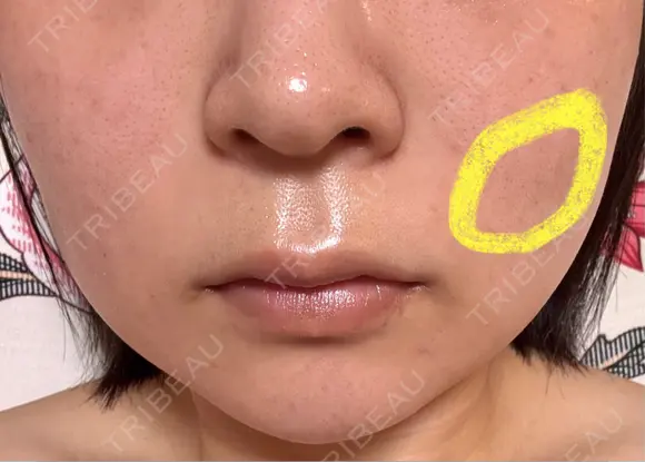 糸リフト / バッカルファット除去 / ボトックス（エラ・小顔） / ヒアルロン酸注入（頬） / フラクショナルレーザー（毛穴・ニキビ跡） TCB東京中央美容外科 仙台駅前院 DAY 5 メイン用