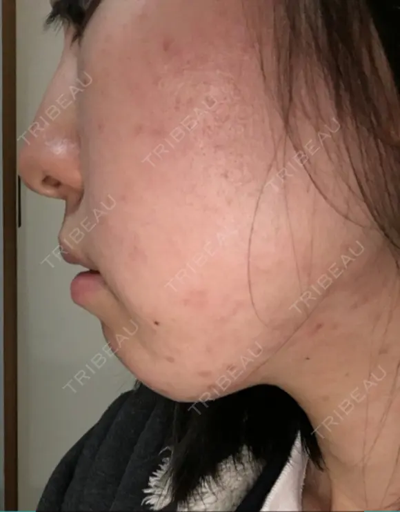 脂肪溶解注射（顔） 湘南美容クリニック 大宮院 DAY 13 メイン用