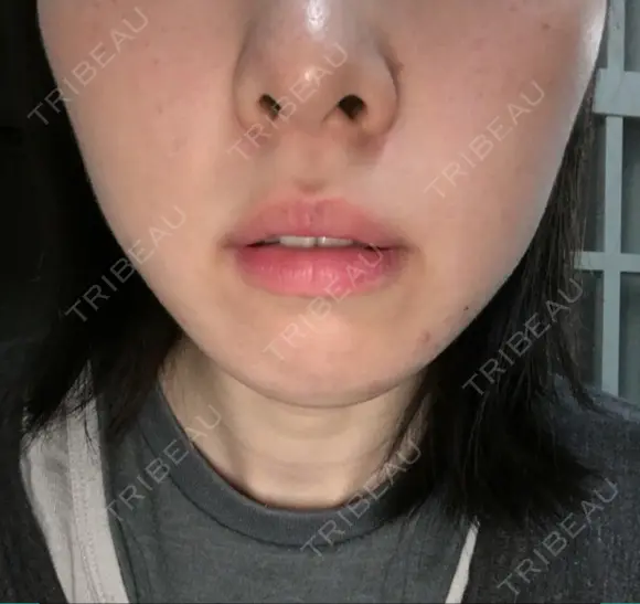 脂肪溶解注射（顔） 湘南美容クリニック 大宮院 DAY 17 メイン用