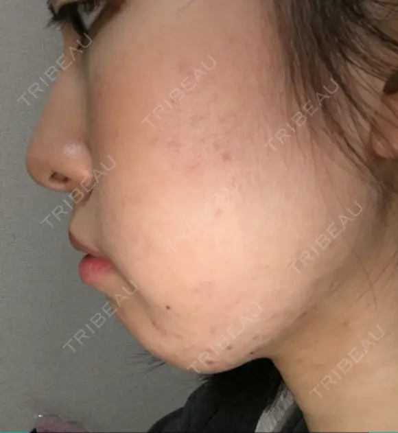 脂肪溶解注射（顔） 湘南美容クリニック 大宮院 DAY 17 メイン用