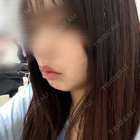 ヒアルロン酸注入（唇） / ボトックス（口角） ルラ美容クリニック 大阪本院 DAY 0 メイン用