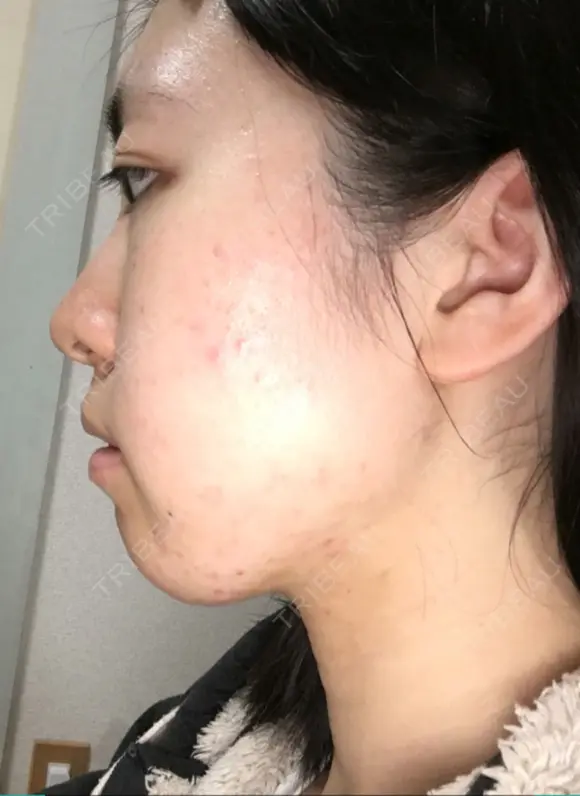 脂肪溶解注射（顔） 湘南美容クリニック 大宮院 AFTER メイン用
