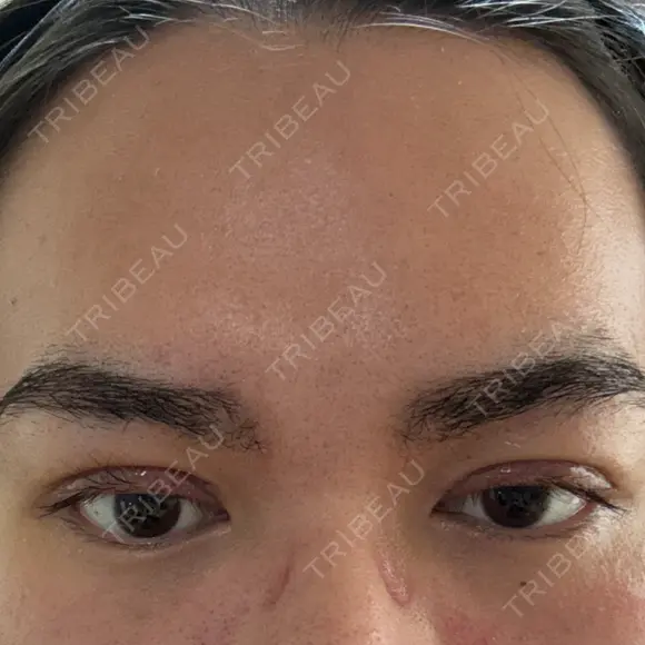 眼瞼下垂（切開） / 上まぶたの脂肪取り 新前橋かしま眼科形成外科クリニック DAY 5 メイン用