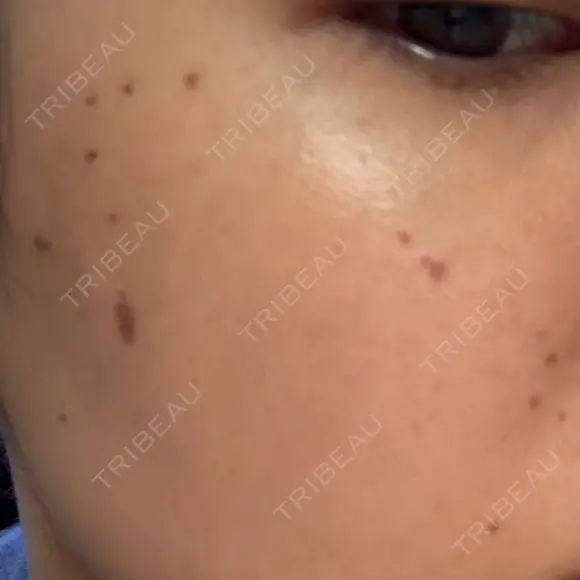 ピコスポット ビューティー和心クリニック 浅草院 DAY 2 メイン用